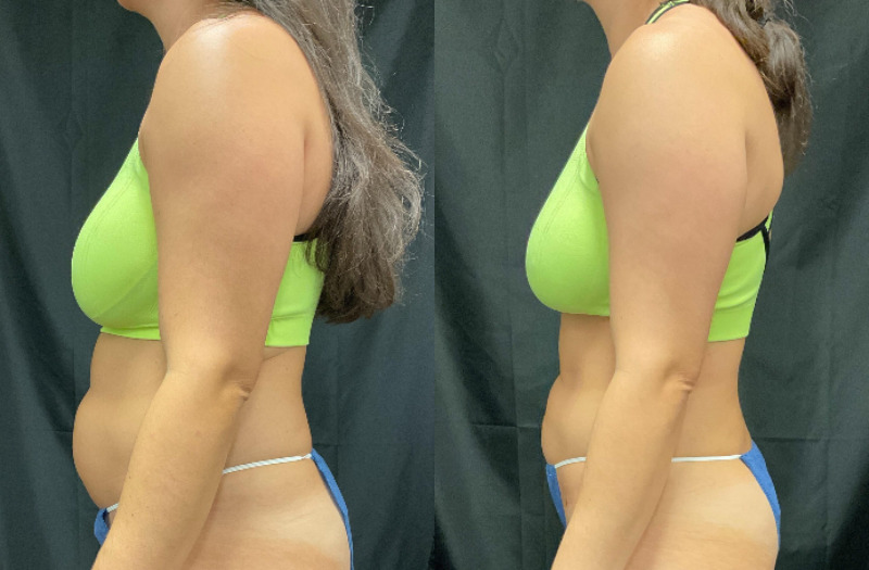 before and after liposuction