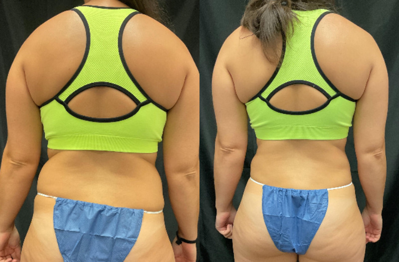 before and after liposuction