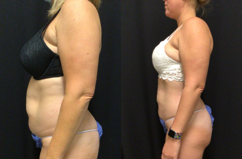 before and after liposuction