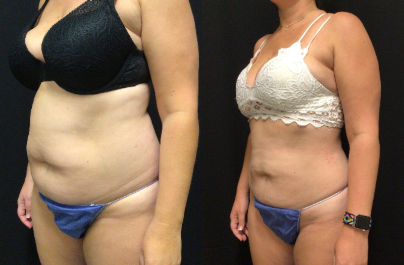 before and after liposuction