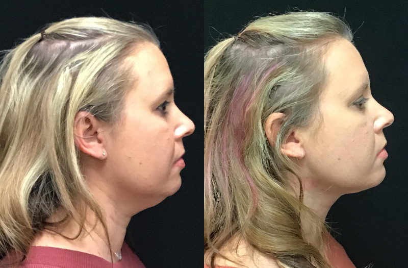 before and after liposuction