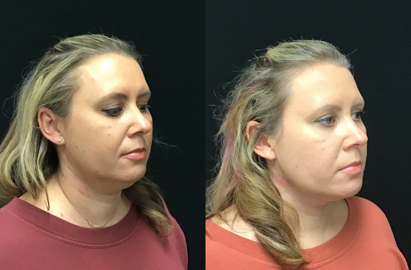 before and after liposuction