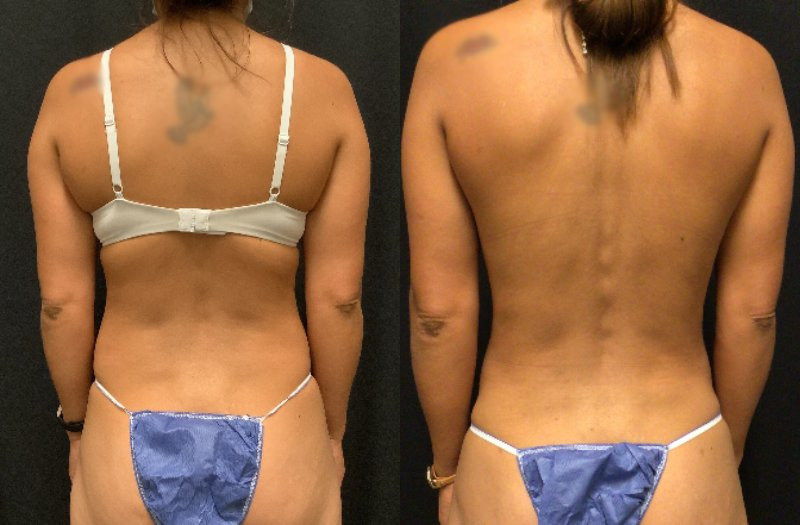 before and after liposuction