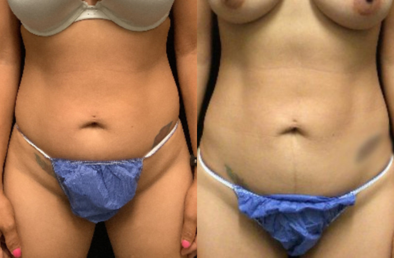 before and after liposuction