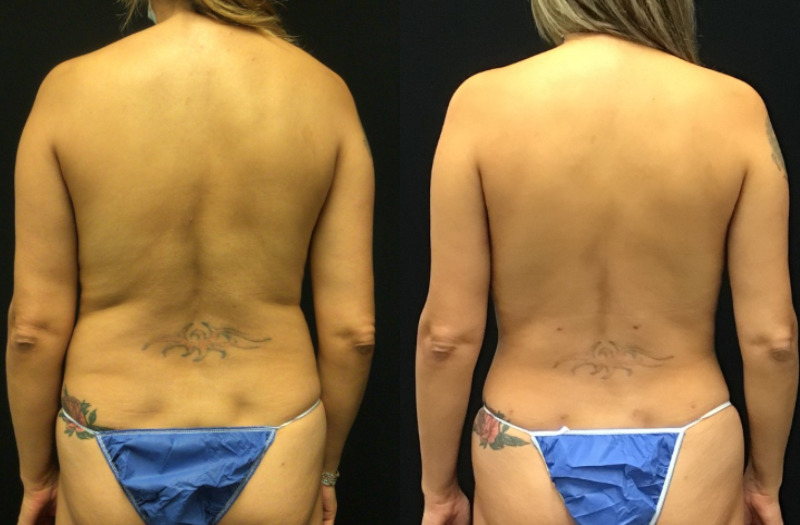 before and after liposuction