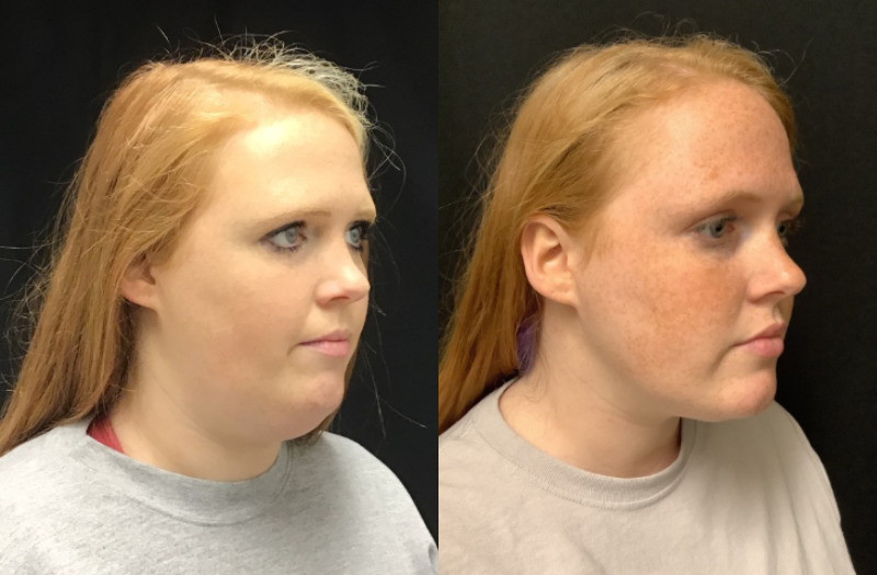 before and after liposuction