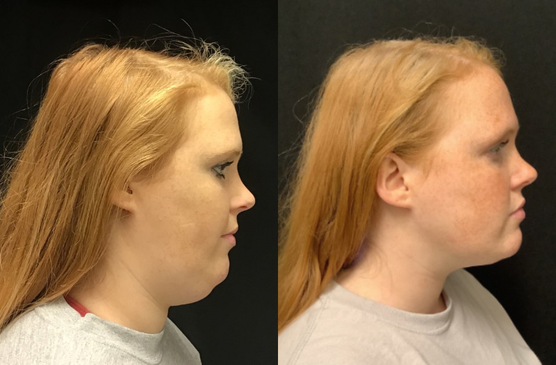 before and after liposuction