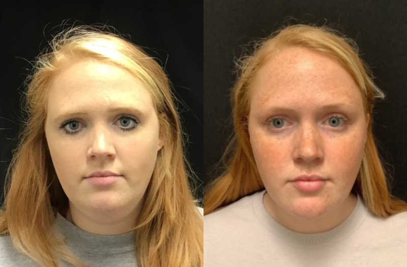 before and after liposuction