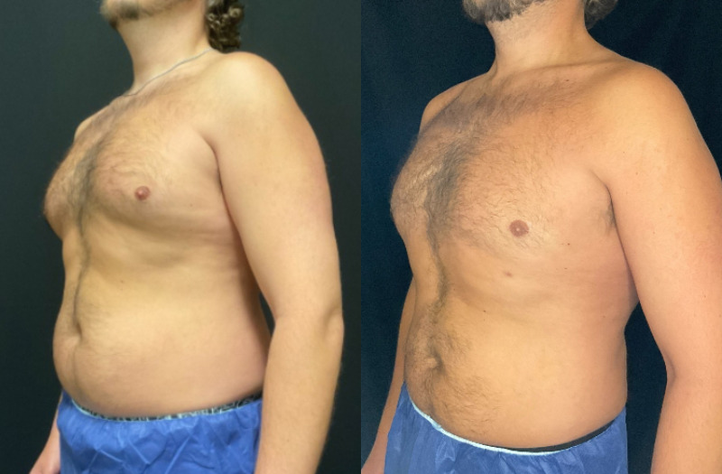 before and after liposuction