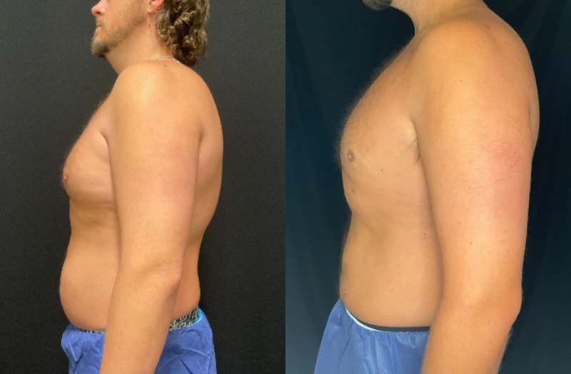before and after liposuction