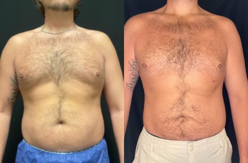 before and after liposuction