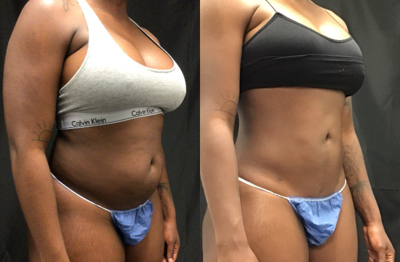 before and after liposuction