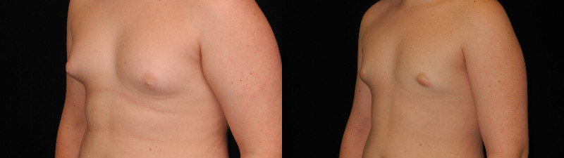before and after male breast reduction
