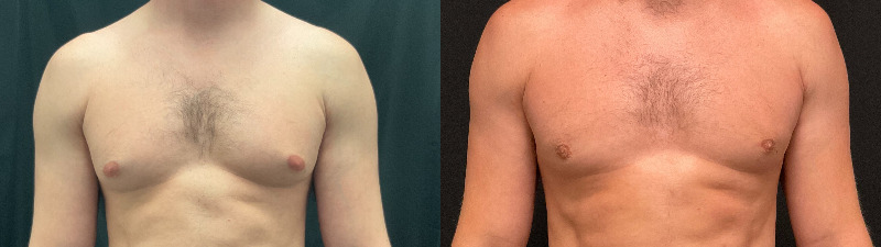 before and after male breast reduction