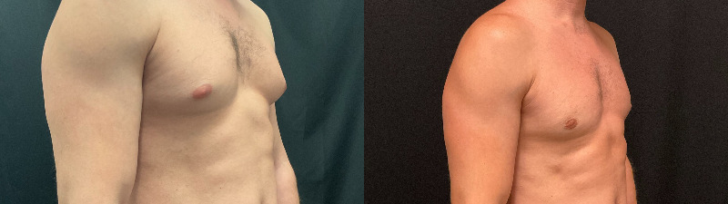 before and after male breast reduction