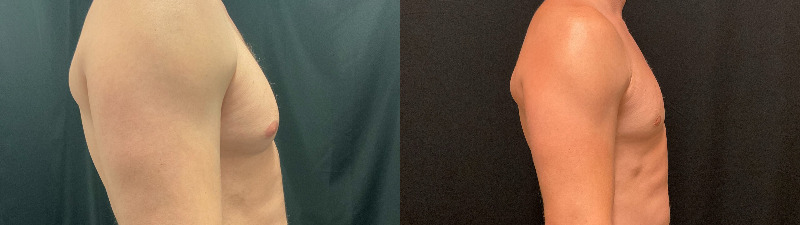 before and after male breast reduction