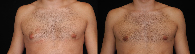 before and after male breast reduction