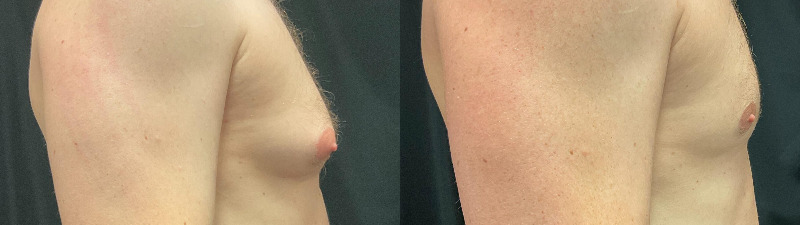 before and after male breast reduction