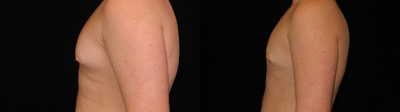 before and after male breast reduction