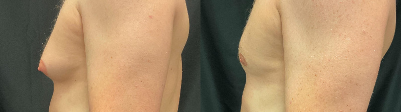 before and after male breast reduction