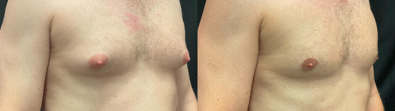 before and after male breast reduction