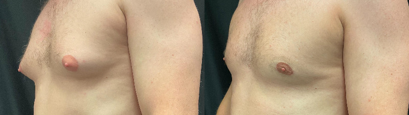 before and after male breast reduction