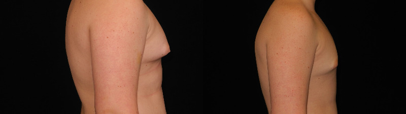 before and after male breast reduction