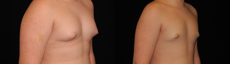 before and after male breast reduction