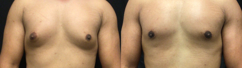 before and after male breast reduction