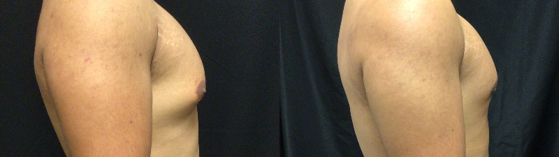 before and after male breast reduction