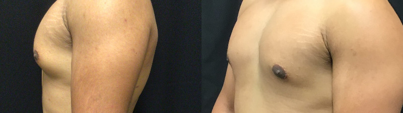before and after male breast reduction