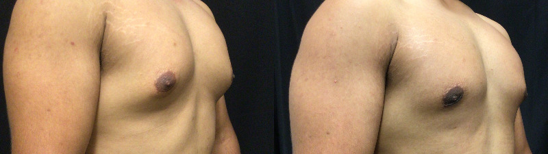 before and after male breast reduction