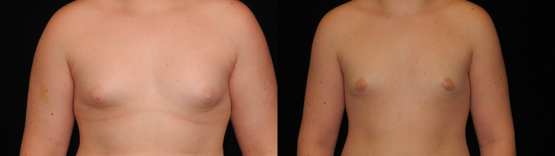 before and after male breast reduction