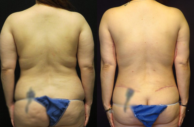 before and after mommy makeover