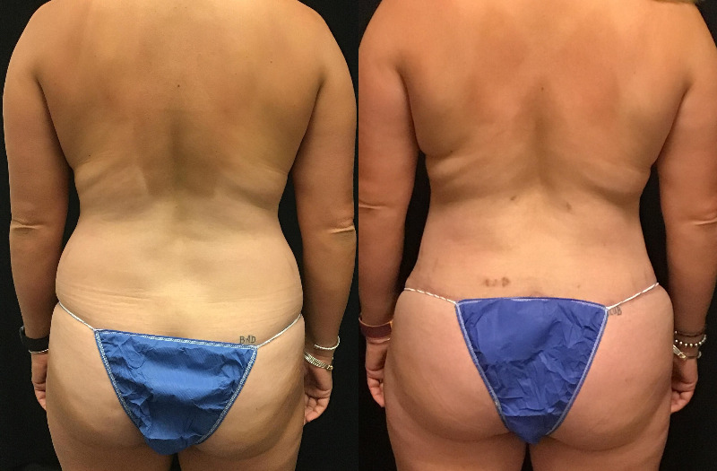 before and after mommy makeover