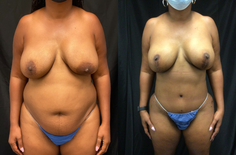 before and after mommy makeover
