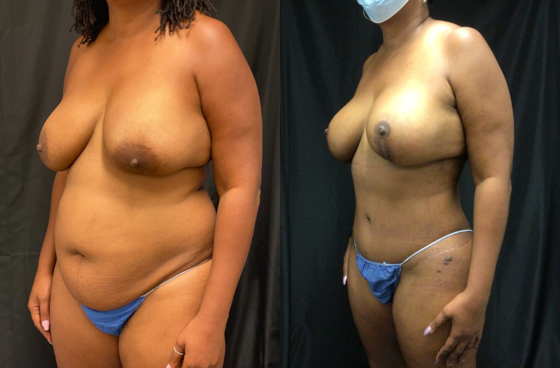 before and after mommy makeover