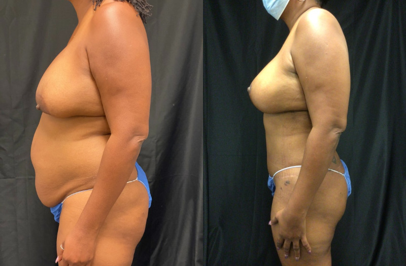 before and after mommy makeover