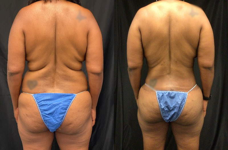 before and after mommy makeover