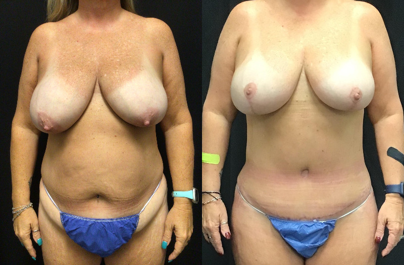 before and after mommy makeover