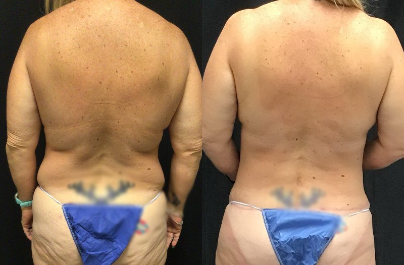 before and after mommy makeover