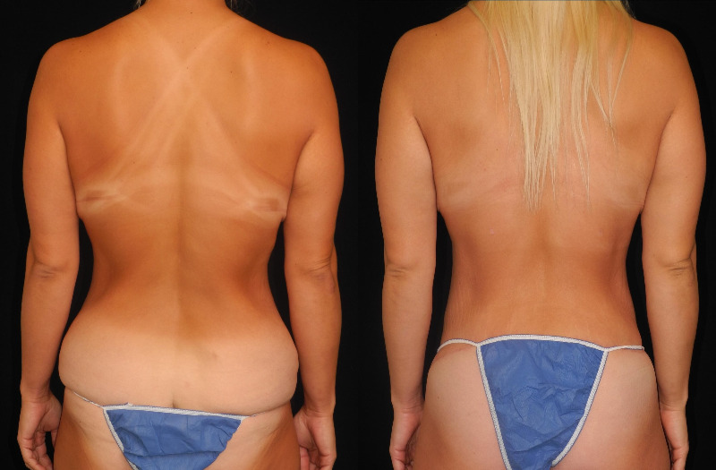 before and after mommy makeover