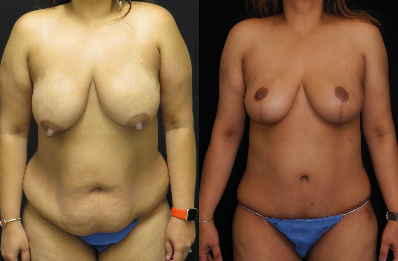 before and after mommy makeover