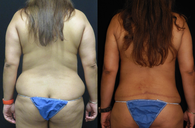 before and after mommy makeover