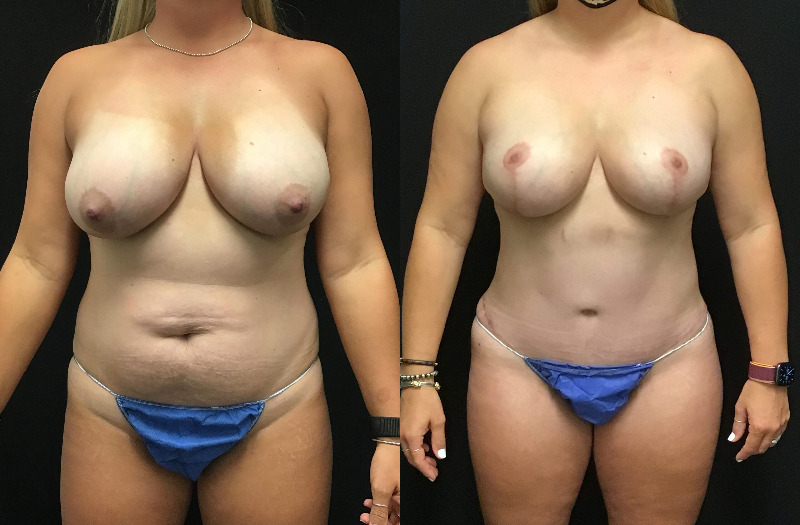 before and after mommy makeover