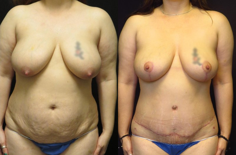 before and after mommy makeover