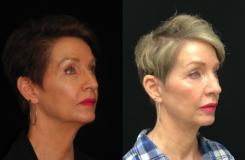 before and after neck lift