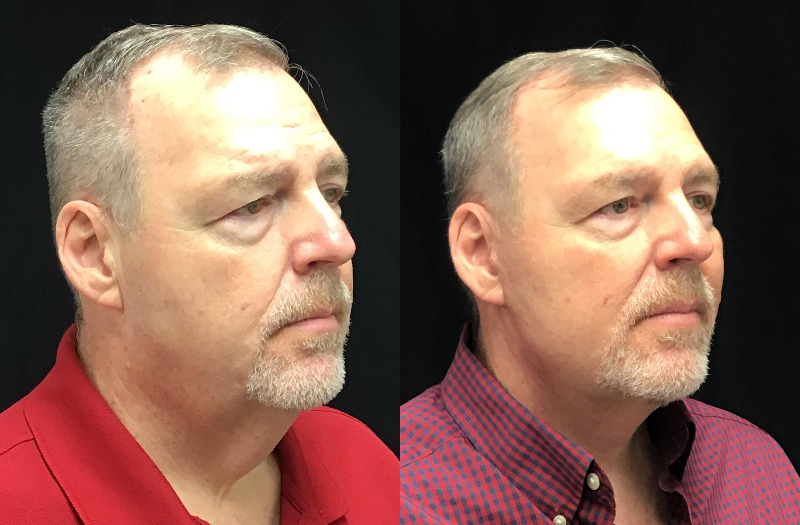 before and after neck lift