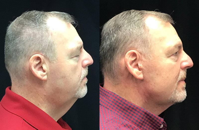 before and after neck lift