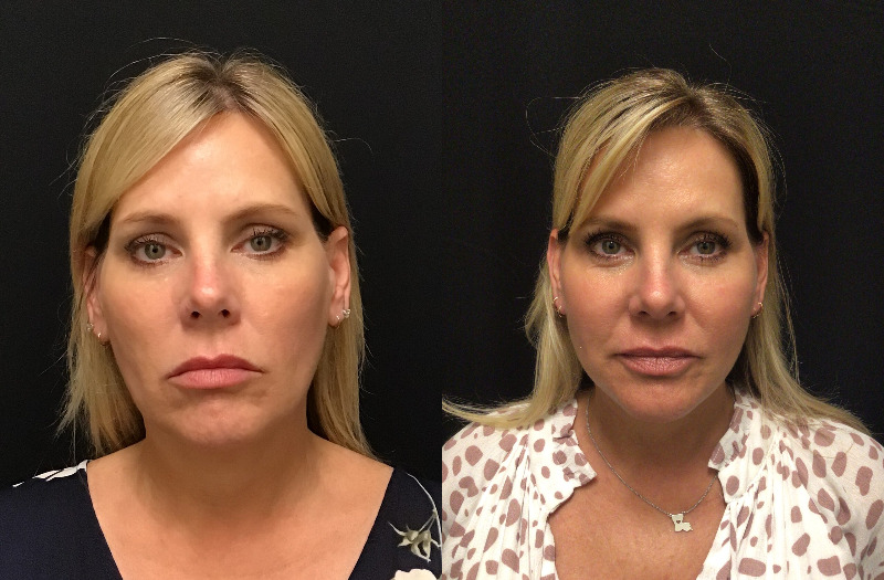 before and after neck lift